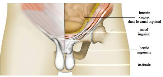 Hernie inguinale