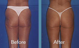 before and after woman's legs with velashape III treatments
