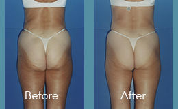 before and after woman's legs with velashape 3 treatments