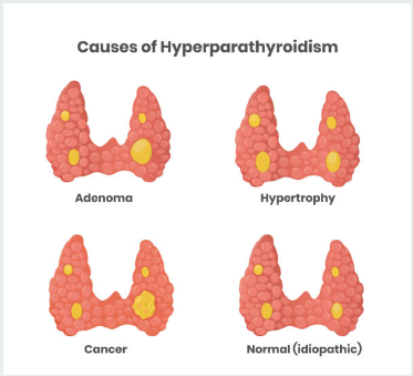 Causes of Hyperparathyroidism