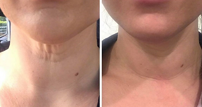 IPL richmond nelson nz, skin tightening richmond nelson nz, www.richmondlaserclinic.co.nz