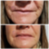 IPL richmond nelson nz, skin tightening richmond nelson nz, www.richmondlaserclinic.co.nz