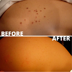 CHERRY ANGIOMAS