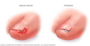 ingrown toenail.jpeg