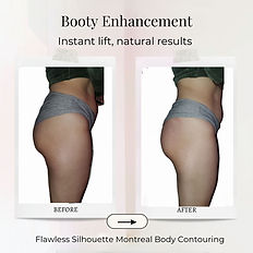 Before and after non-invasive booty enhancement treatment showing a lifted, fuller, and more sculpted appearance.