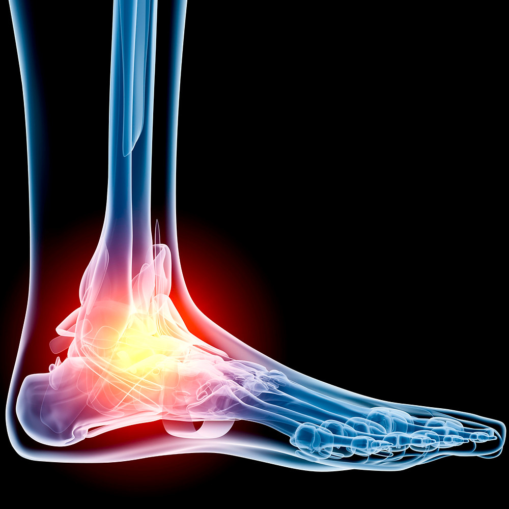 Ankle-Pain-Xray