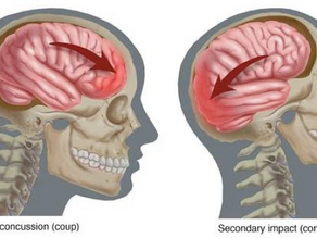 Modern Concussion Care: Moving Beyond Rest Toward Active Recovery