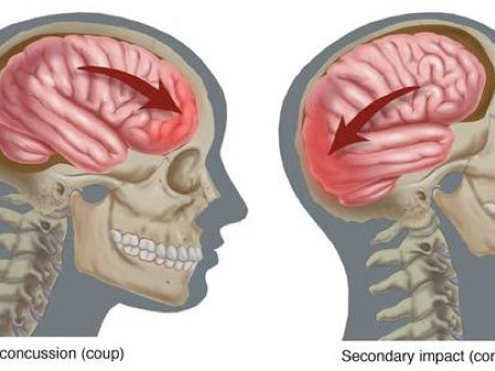 Modern Concussion Care: Moving Beyond Rest Toward Active Recovery