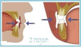 השפעת המוצץ על מבנה השיניים