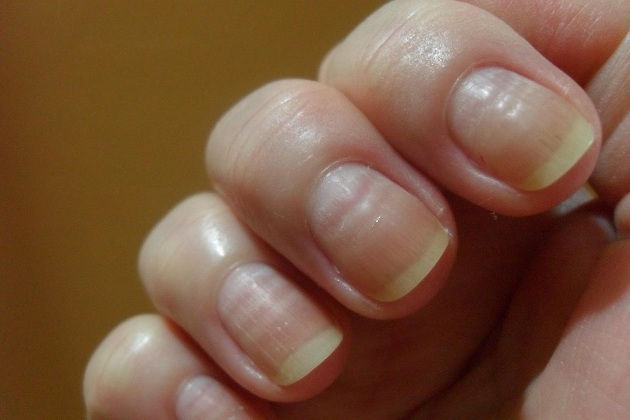 AlteraçÔes das unhas