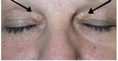 Xantelasma