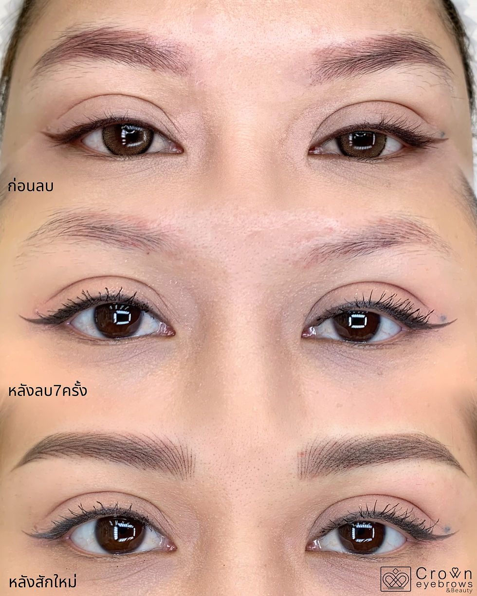 แก้ไขคิ้ว และลบคิ้ว ด้วย Pico Laser ที่ Crown Eyebrows & Beauty ในกรุงเทพ หลักสี่