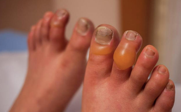 Blistering but no black or dead tissue.