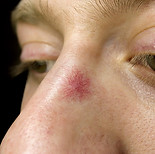meredithbaylaser-newhampshire-telantagias.jpg