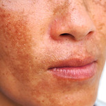 meredithbaylaser-newhampshire-melasma.jpg