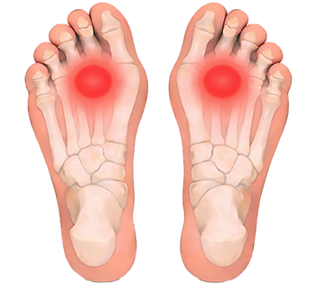 Metatarsalgia Final_edited.png