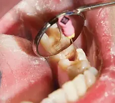 Retratamento-de-Canal-Endodontista.webp