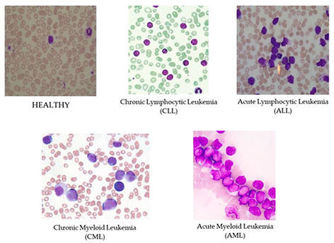 Sample-images-of-four-different-types-of-Leukemia-Chronic-Lymphocytic-Leukemia-CLL.png