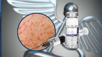 An additional confirmed case of measles in Los Angeles County.