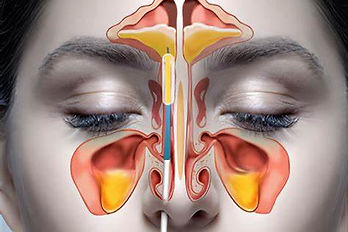 sinus surgery.jpg