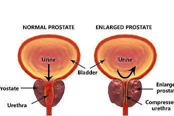 Enlarged-Prostate.jpg