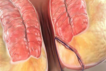 anal fistula.jpg