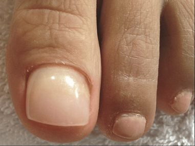 KeryFlex after treatment.png