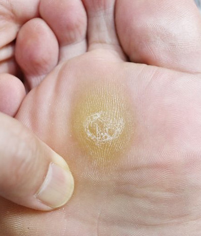 Pain- free callus removal