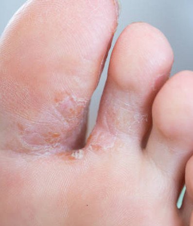 We treat tinea/ Athletes foot