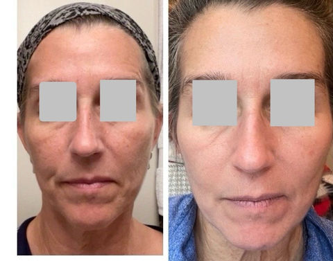 before and after using Obagi Nu-Derm Rx