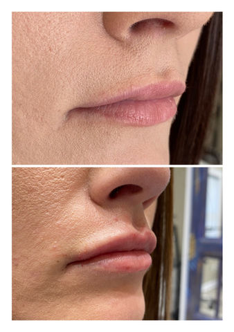 before and after 1 syringe of Versa