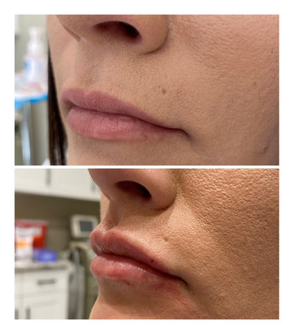 before and after 1 syringe of Versa