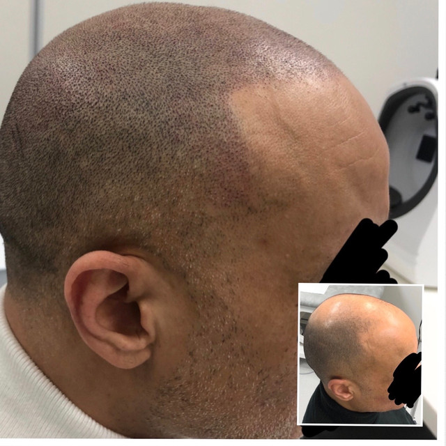 micro haar pigmentatie project scalp