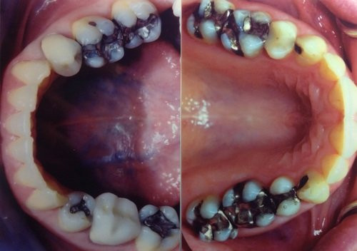 Amalgam fillings - mercury detox