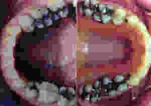 Amalgam fillings - mercury detox