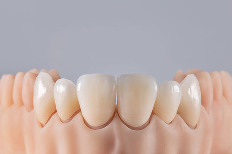 Six ceramic crowns on silicone gums Dental model of teeth front view .jpg