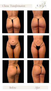 Body contouring results after lipo and transfer lift procedure