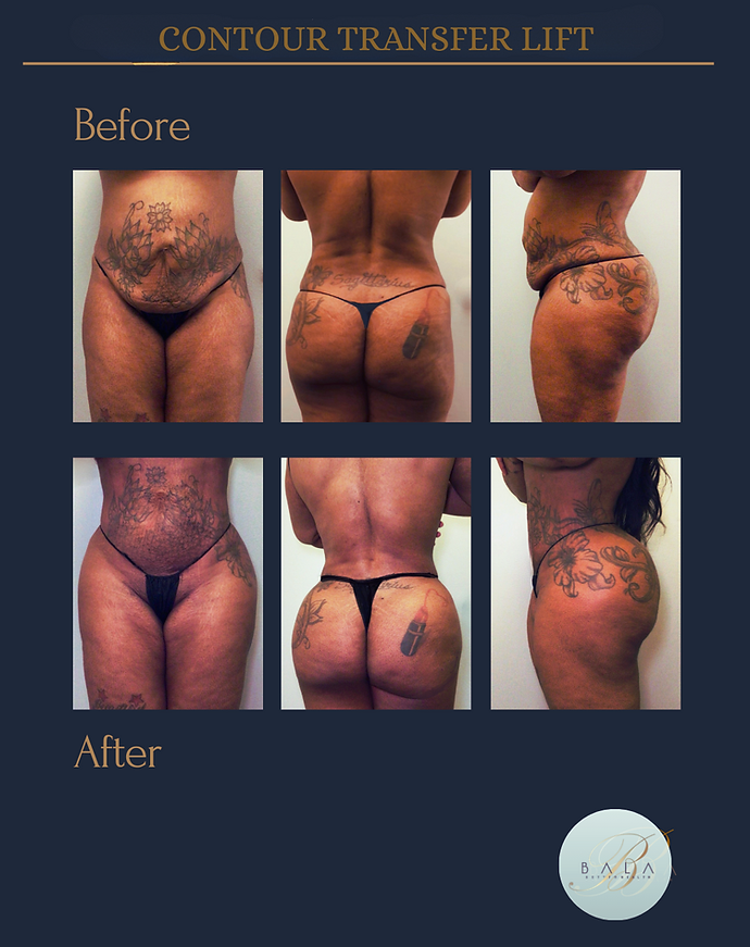 Before and after results of lipo and body contouring at Bala Better Health Med Spa Philadelphia