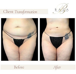 Close-up body contouring results after lipo and transfer lift procedure