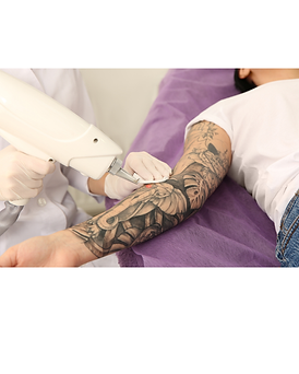 Laser tattoo removal treatment being performed on a client's forearm using advanced laser technology.