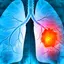 What is the best way to survive lung cancer and its symptoms and treatment?