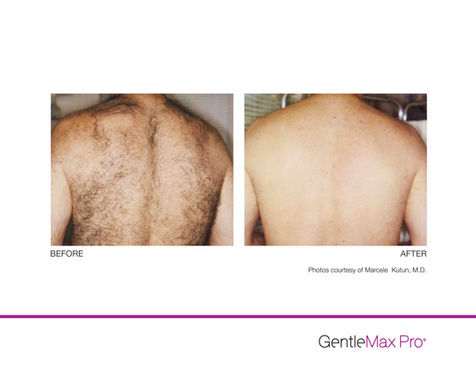GentleMax-HR-P1-MKutun-MD_highres copy.jpeg