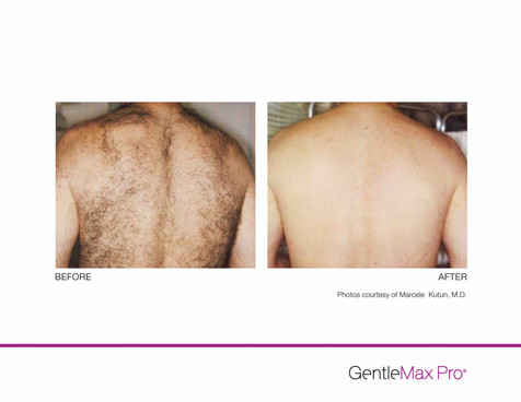GentleMax-HR-P1-MKutun-MD_highres copy.jpeg