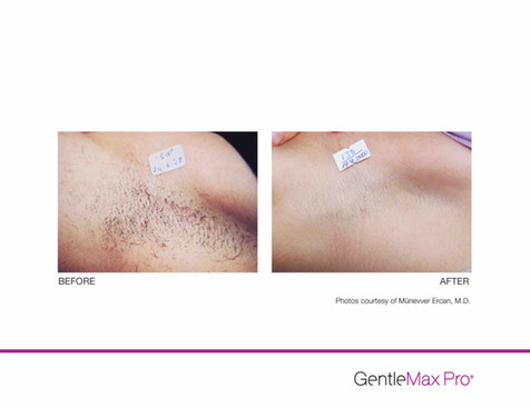 GentleMax-HR-P1-MErcan-MD_highres copy.jpeg