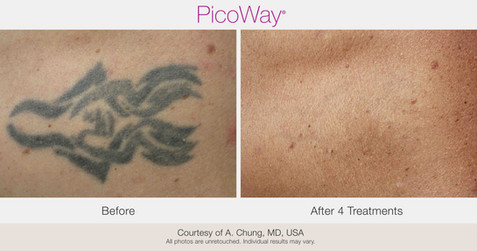 PicoWay_BAs_AChung-Tattoo-post4Tx-16 copy.jpeg