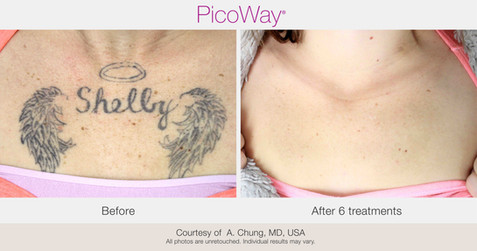 BA-PicoWay-AChung-ChestTattoo-13tx copy-min.jpeg