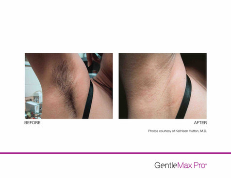 GentleMax-HR-P1-KHutton-MD_highres copy.jpeg