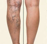 VARICES