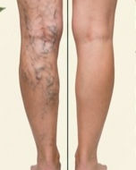 VARICES
