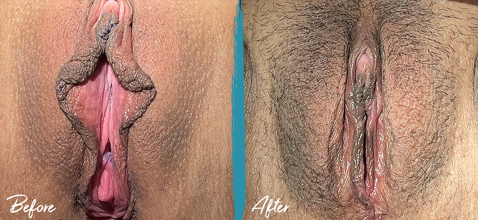 6 weeks post-op vaginoplasty and vy wedge labiaplasty